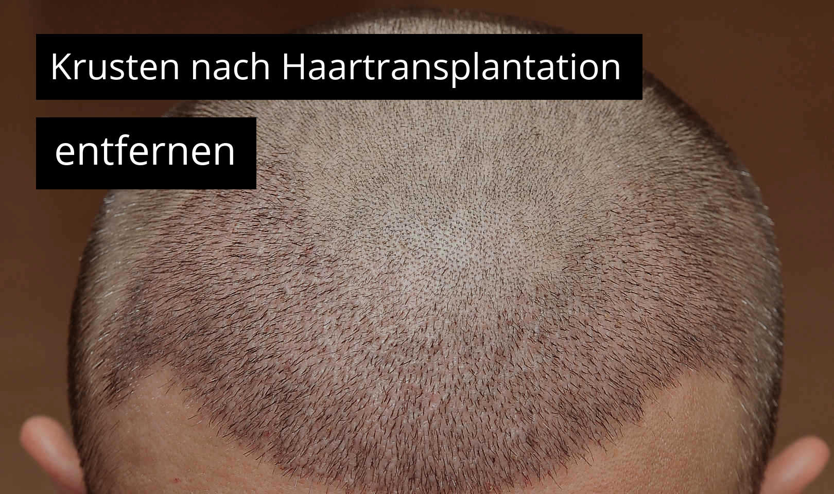 Krusten nach Haartransplantation entfernen