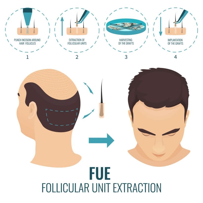FUE Follicular Unit Extraction