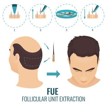 FUE Follicular Unit Extraction