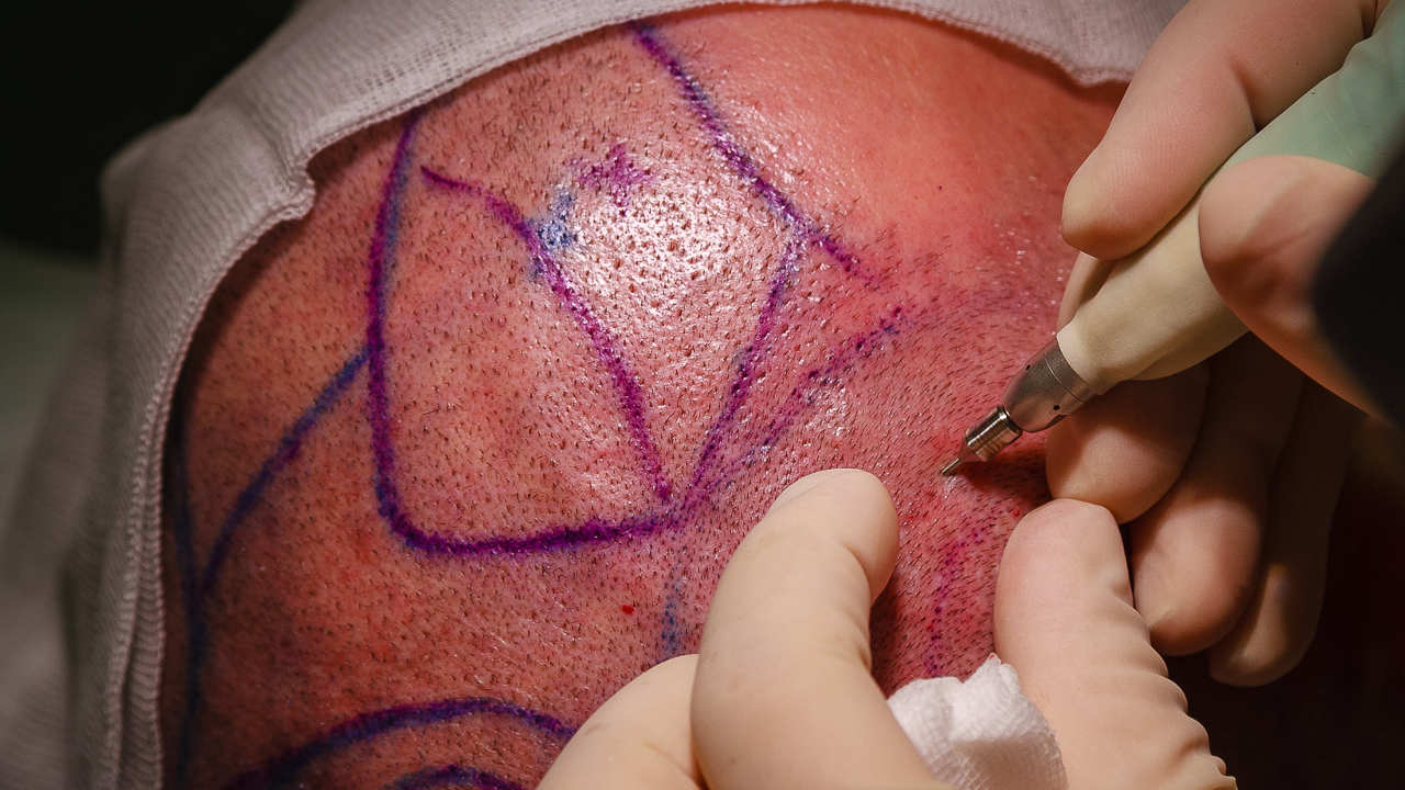 Fue Haartransplantation Fue Haartransplantation