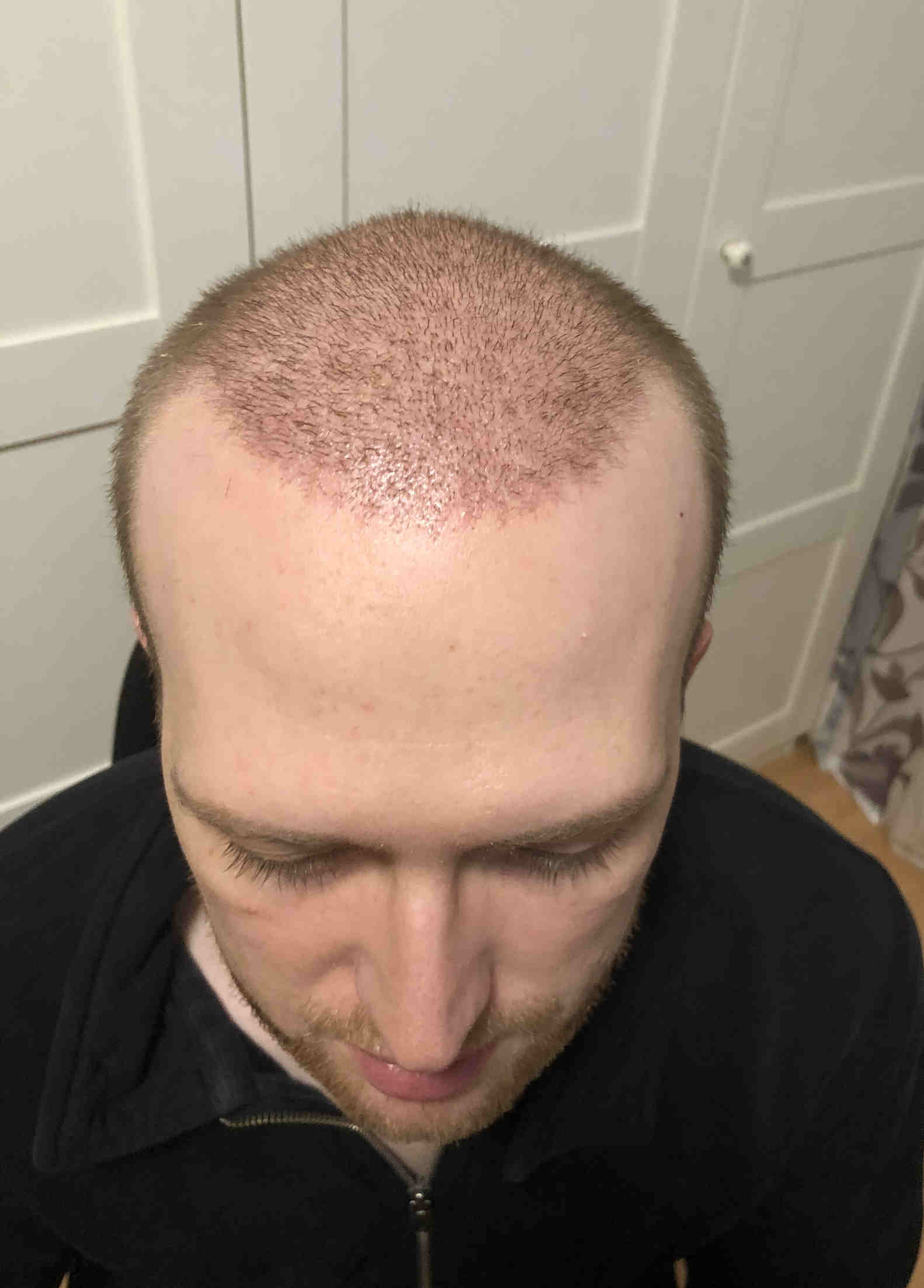 2 Wochen nach Haartransplantation 2 Wochen nach Haartransplantation