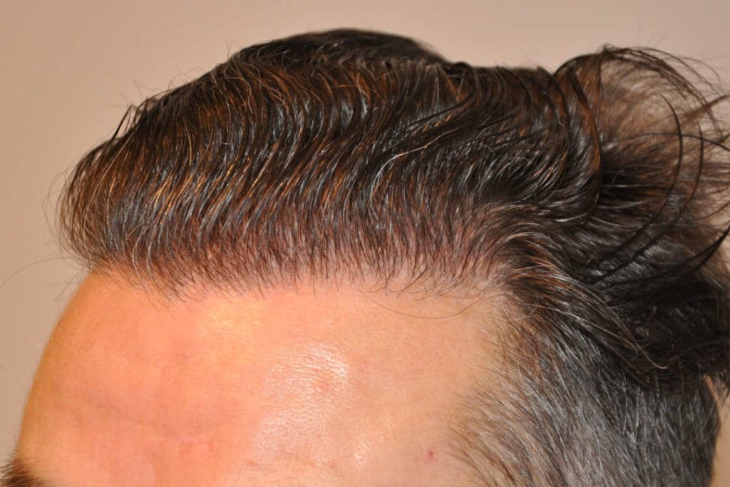 Natürliche Haarlinie