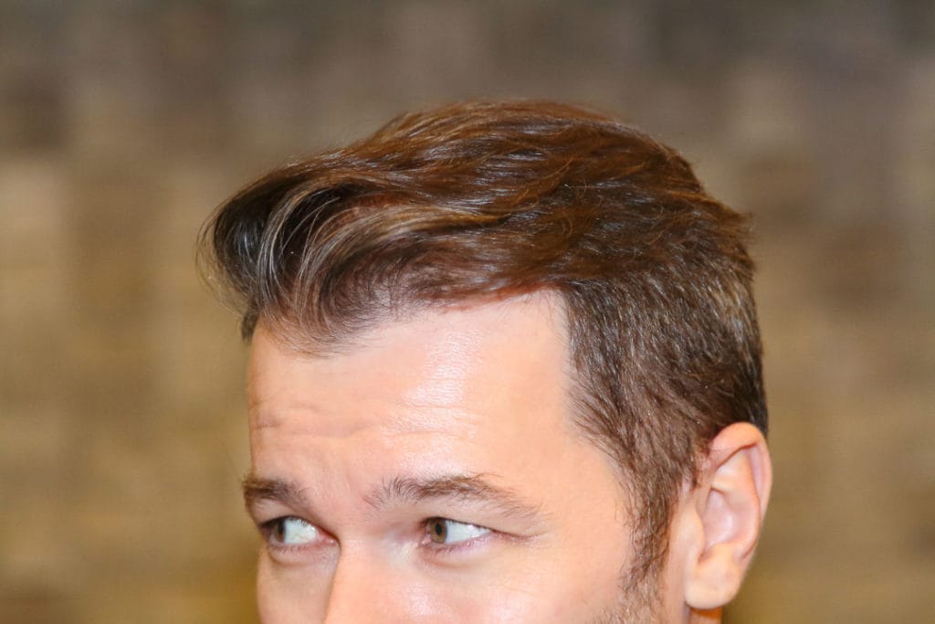 Wann kann man von Erfolg bei einer Haartransplantation sprechen?