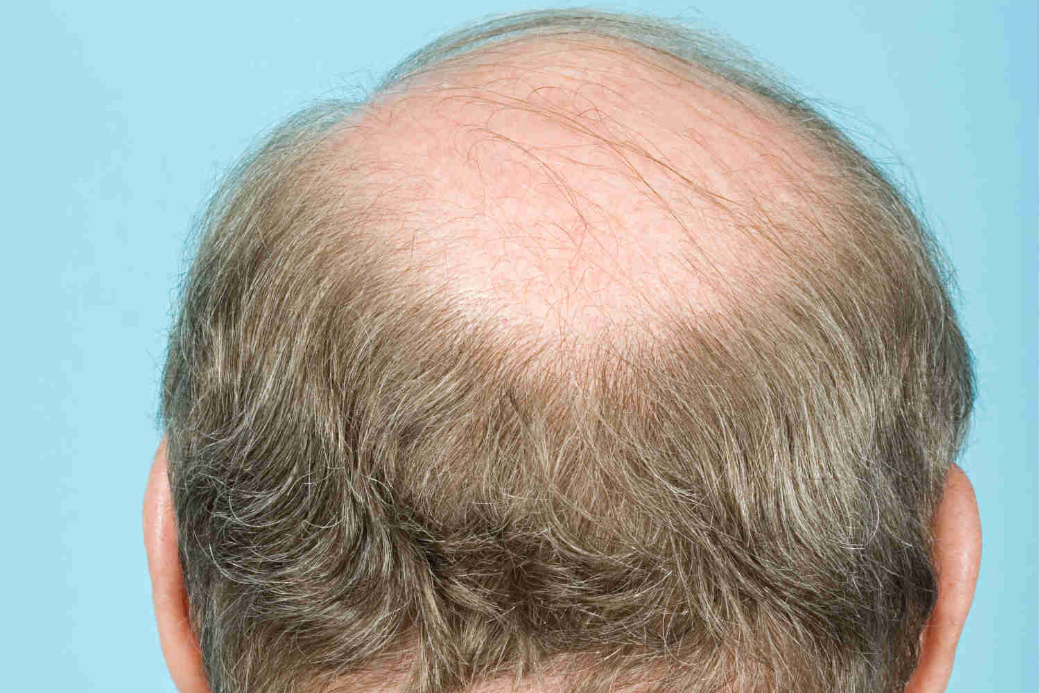 Haartransplantation bei Tonsur