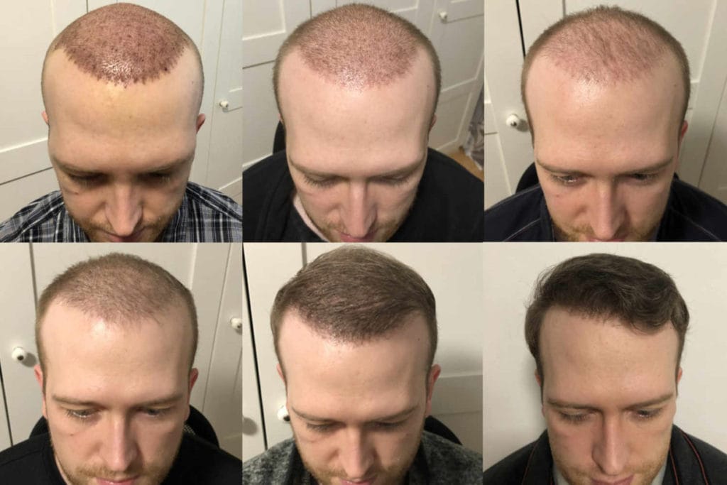 Haartransplantation Verlauf in Bildern Haartransplantation Verlauf in Bildern - Zeitraffer