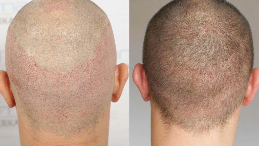Spenderbereich nach Haartransplantation