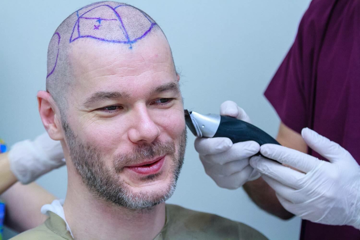 haartransplantation-rasur