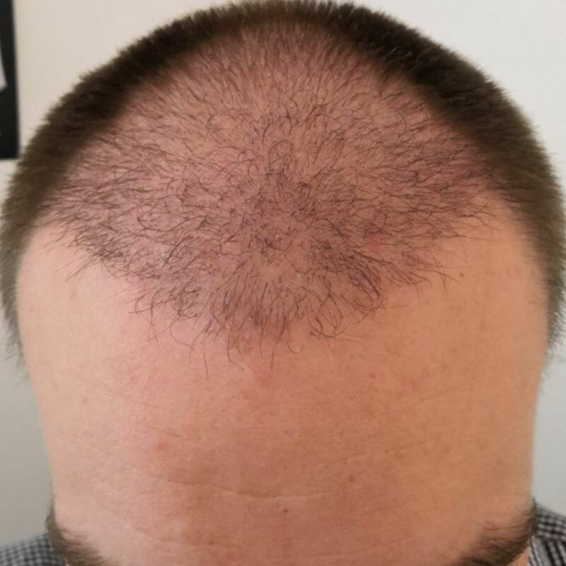 3-monate-nach-haartransplantation
