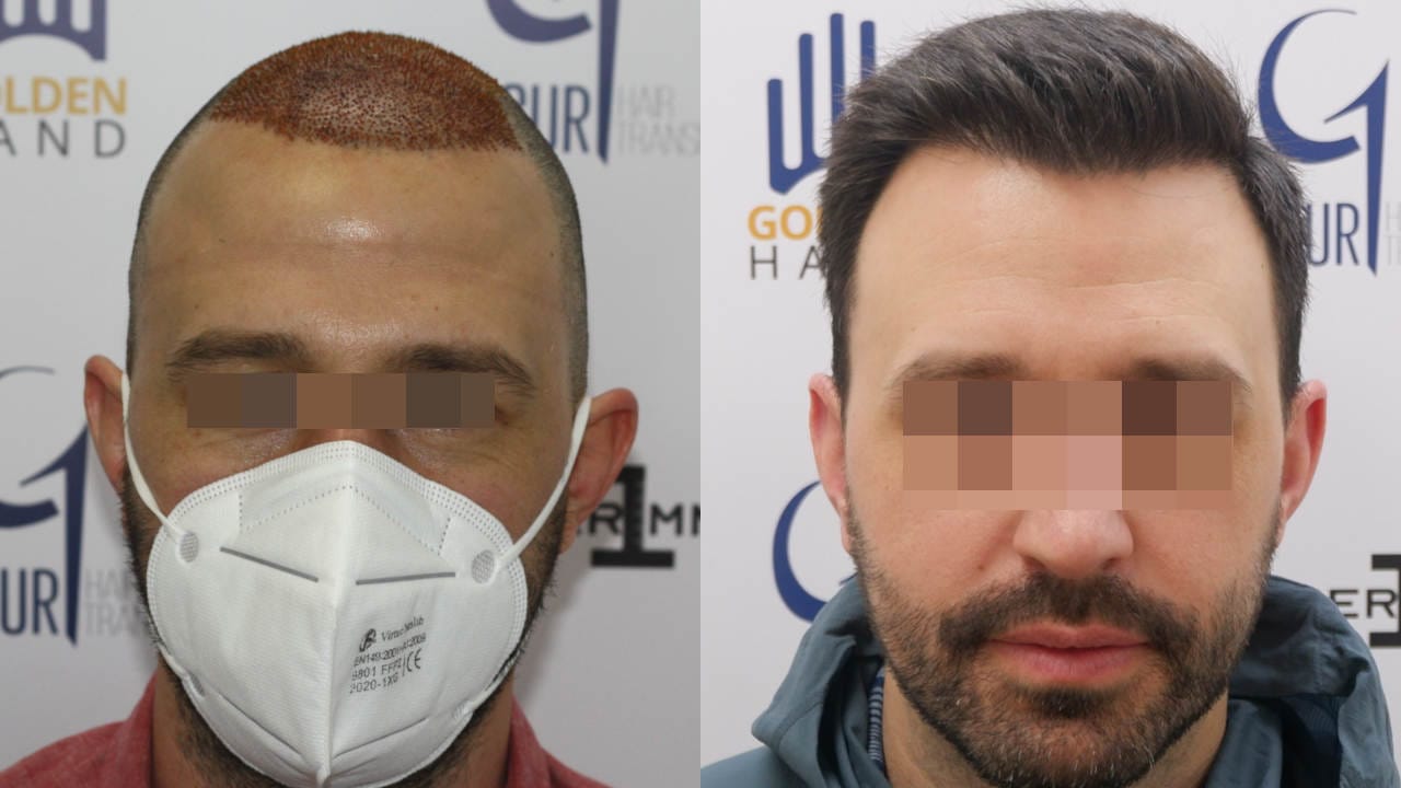 Haartransplantation Türkei 3400 Grafts