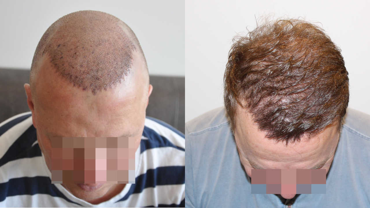 Haartransplantation Türkei Ergebnis 4000 Grafts