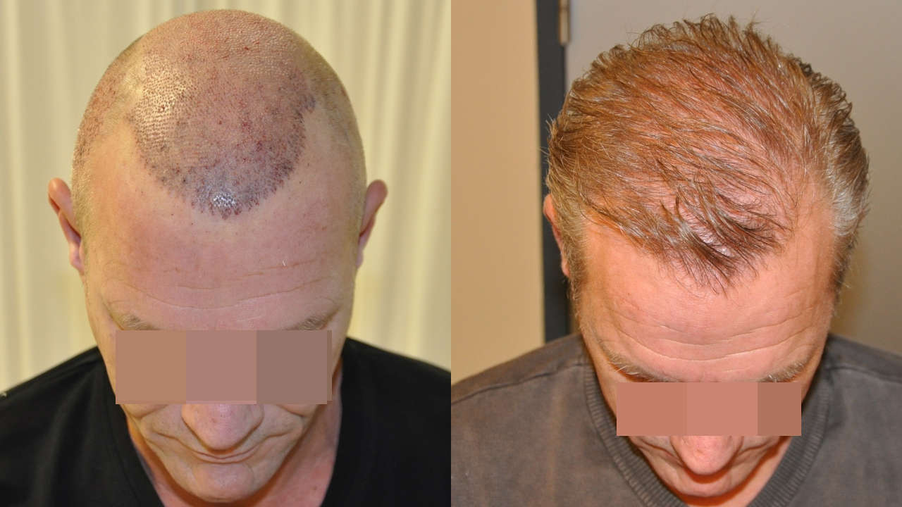 Haartransplantation Türkei Ergebnis 4100 Grafts