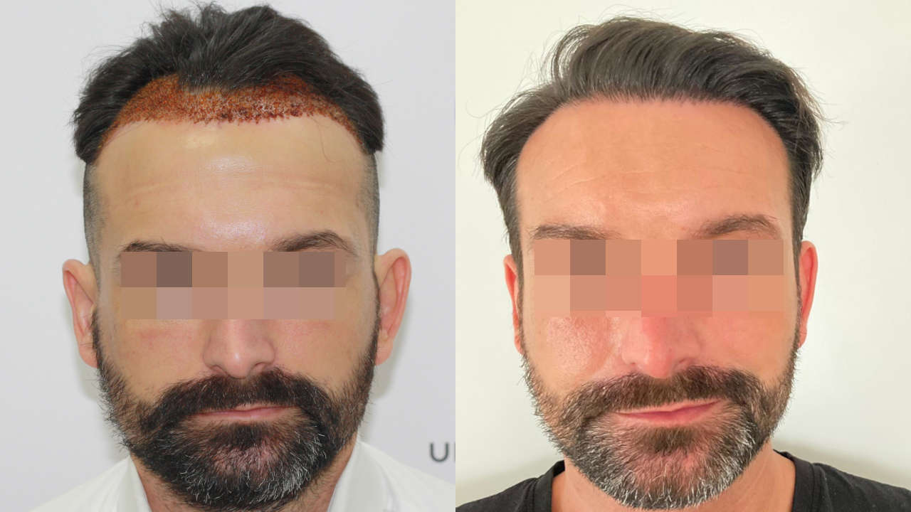 Haartransplantation Türkei Ergebnis 3450 Grafts