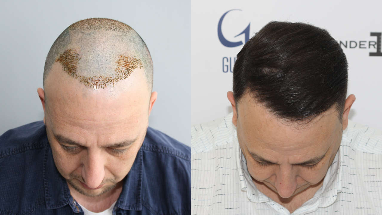 Haartransplantation Türkei Ergebnis 5500 Grafts