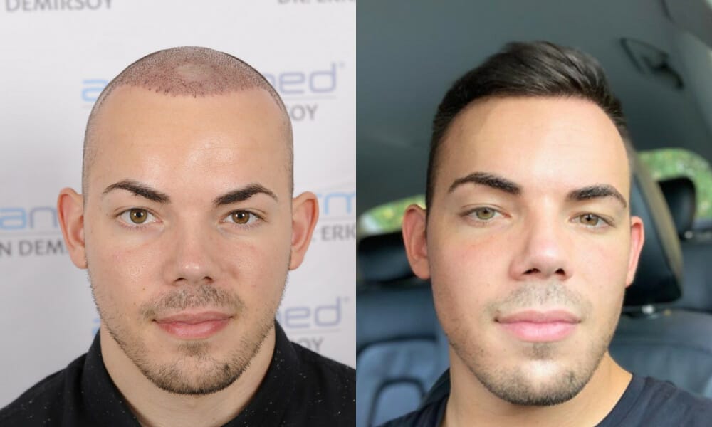 haartransplantation-tuerkei-erfahrungen-health-travels