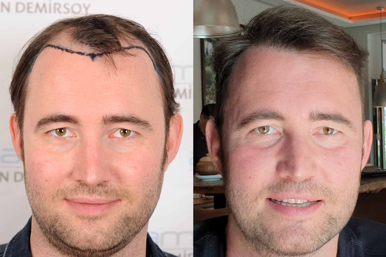 haartransplantation-tuerkei-kosten