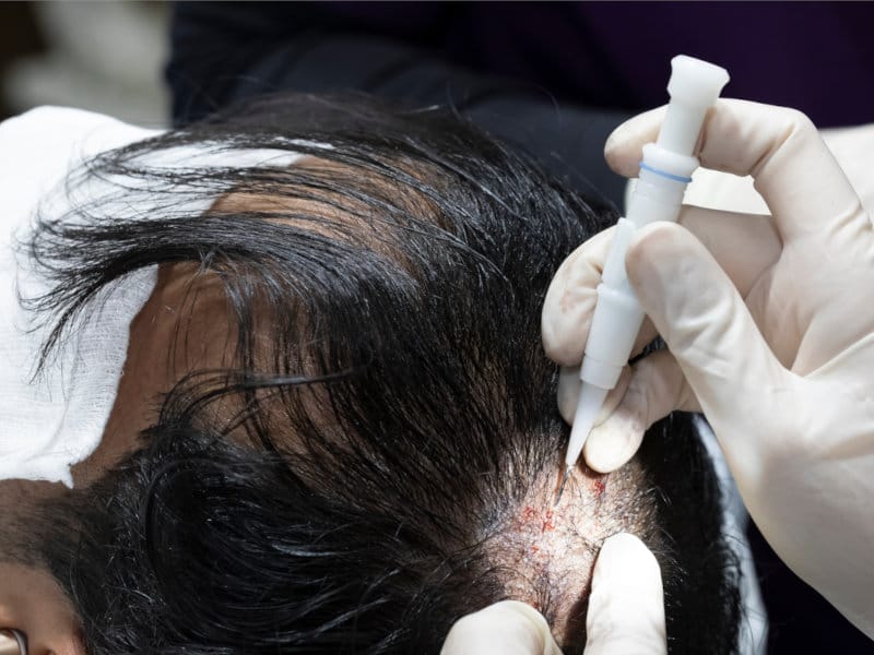 dr-hakan-clinic-dhi-haartransplantation Dr. Hakan Clinic DHI Haartransplantation