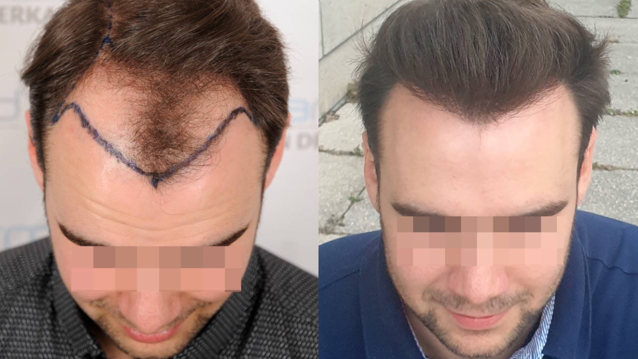 marc-vorher-nachher